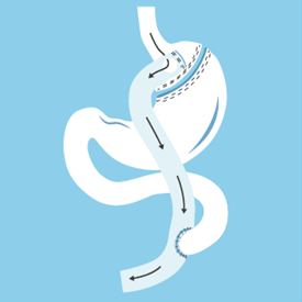 Gastric bypass diagram